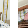 隨州市中心醫(yī)院：惡性包塊切除+自體皮移植，87歲老奶奶變美了！