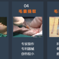 【招募志愿者】“脫發(fā)”有救了！ 隨州市中心醫(yī)院醫(yī)療美容科面向社會招募“毛發(fā)移植”體驗(yàn)者！
